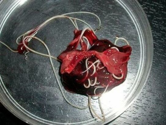 robaki z ludzkiego ciała